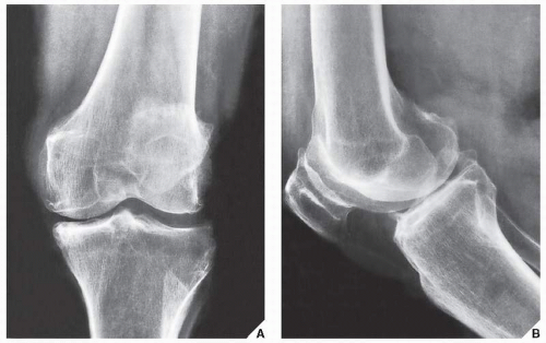 Degenerative Joint Disease | Radiology Key