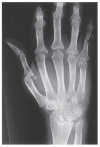 Miscellaneous Arthritides and Arthropathies | Radiology Key
