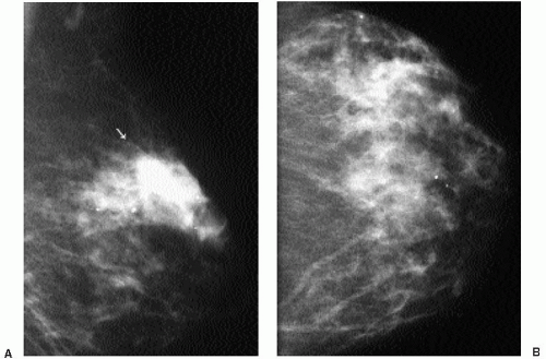 Screening Mammography | Radiology Key