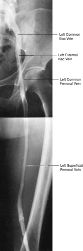 Upper Extremity Venous Anatomy Ct