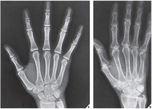 Radiologic Evaluation of Metabolic and Endocrine Disorders | Radiology Key