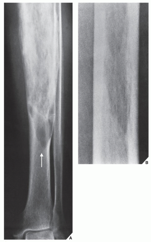 Paget Disease | Radiology Key