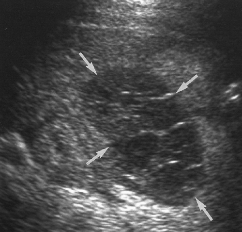 abdominal sonogram