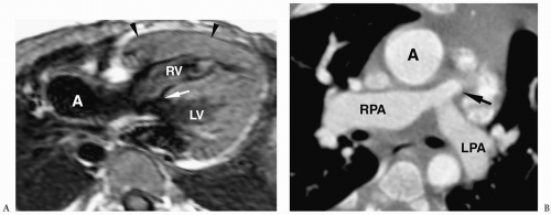 Heart | Radiology Key