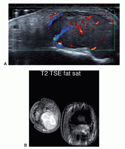 Soft Tissue Masses | Radiology Key