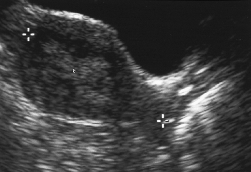 Female Pelvis Ultrasound Radiology Key