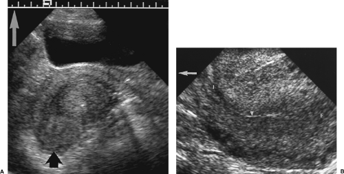 retroverted uterus transabdominal ultrasound