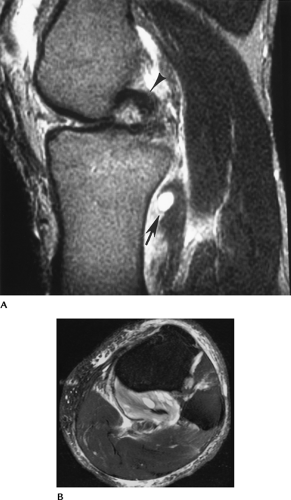 Knee | Radiology Key