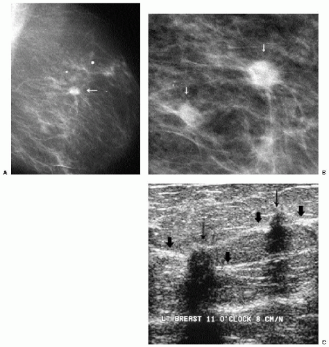 A 60-year-old patient presented by a lump in the left breast