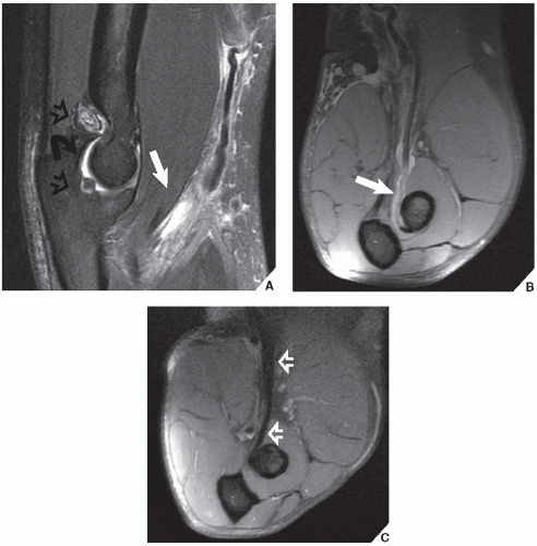 Upper Limb II: Elbow | Radiology Key