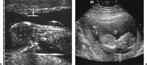 Obstetric Ultrasound First Trimester Radiology Key 