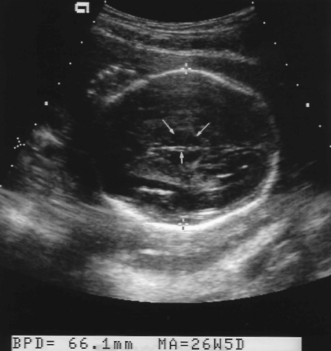 Obstetric Ultrasound–Second and Third Trimester