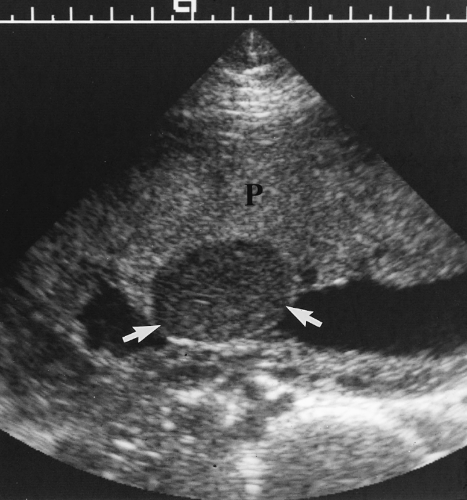 Chorangioma Ultrasound
