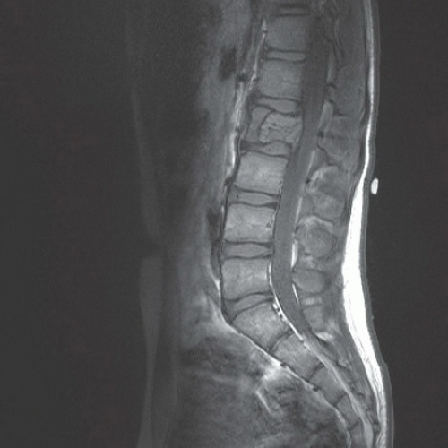 Neuroradiology: Spine Imaging | Radiology Key