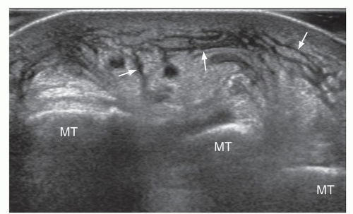 Soft Tissue Masses Radiology Key