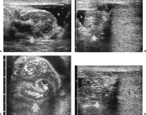 Scrotal Ultrasound | Radiology Key