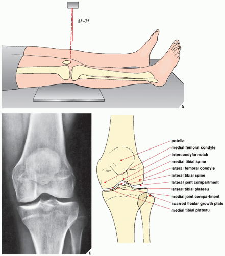Radiographic Positioning Of The Knee