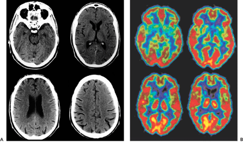 PET Imaging in Dementias and Extrapyramidal Disorders | Radiology Key