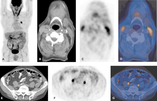 PET-CT and SPECT-CT Body Scans: Artifacts, Normal Variants, Pitfalls ...