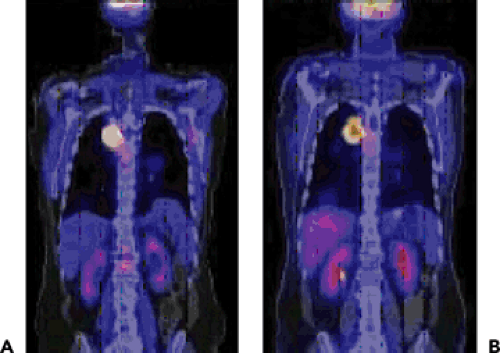 PET and PET-CT in Kidney Tumors and Bladder Cancer | Radiology Key