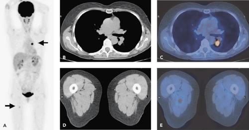 PET-CT and SPECT-CT of Malignant Melanoma | Radiology Key