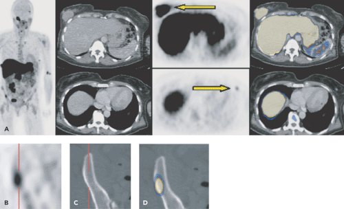 PET and PET-CT in Multiple Myeloma | Radiology Key