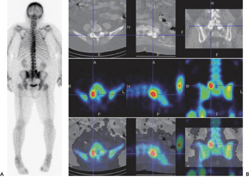 Pet And Pet Ct Of Malignant Pleural Mesothelioma Radiology Key