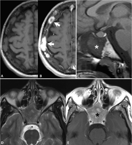 Diploic Space Lesions | Radiology Key