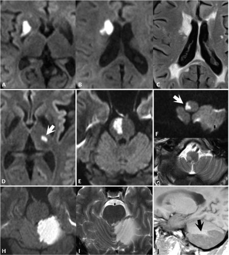 Ischemia and Infarction II | Radiology Key