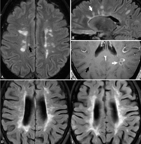 Multiple Sclerosis Radiology Key Multiple Sclerosis Radiology Key