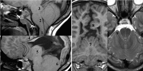Posterior Fossa Congenital Malformations | Radiology Key