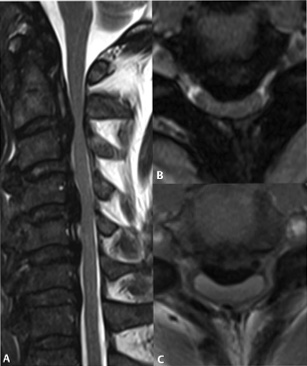 Degenerative Disease | Radiology Key