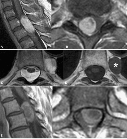 Primary Neoplasms | Radiology Key