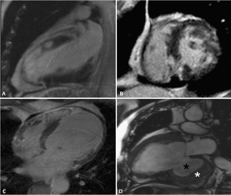 Ischemic Heart Disease | Radiology Key