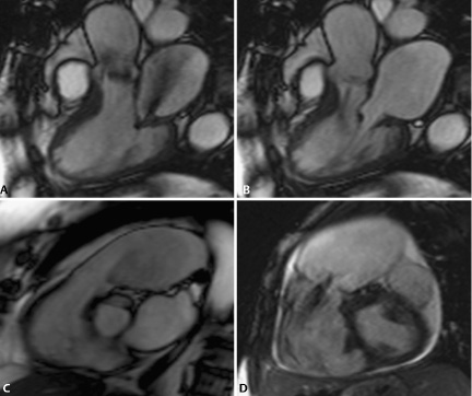 Valvular Heart Disease | Radiology Key