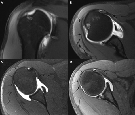 Glenohumeral Instability I | Radiology Key