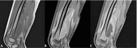 Diploic Space Lesions | Radiology Key