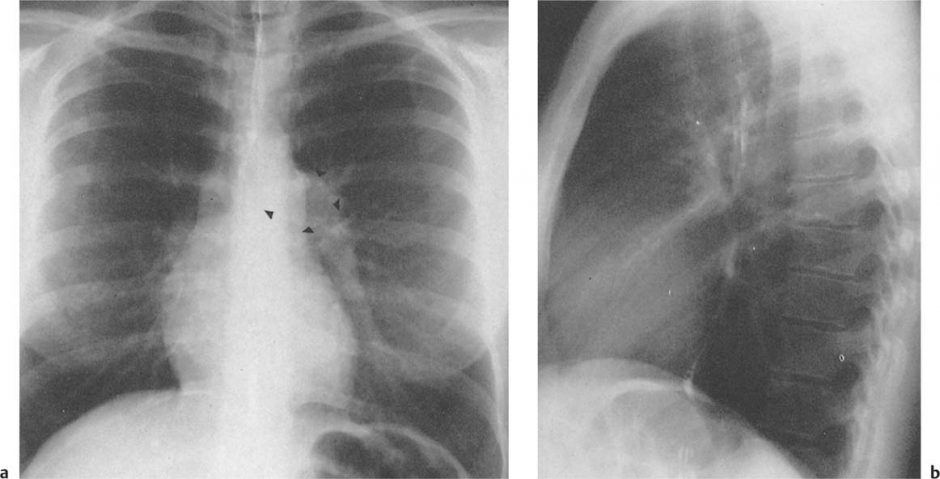 Intrathoracic Calcifications | Radiology Key