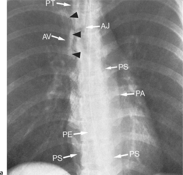 Mediastinal Or Hilar Enlargement Radiology Key