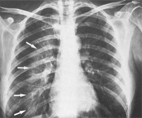 prominent lung artifact meaning