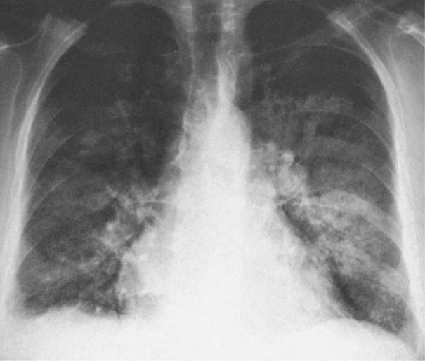 pulmonary edema lung sounds