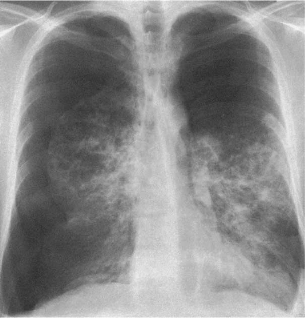 Hyperlucent Lung | Radiology Key