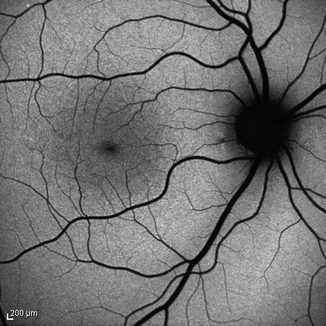 Optical Coherence Tomography As A Biomarker In Clinical Trials For ...