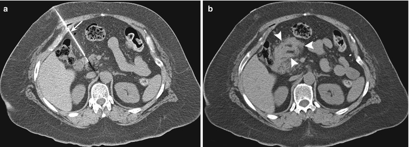 Percutaneous Biopsy Of The Pancreas Radiology Key