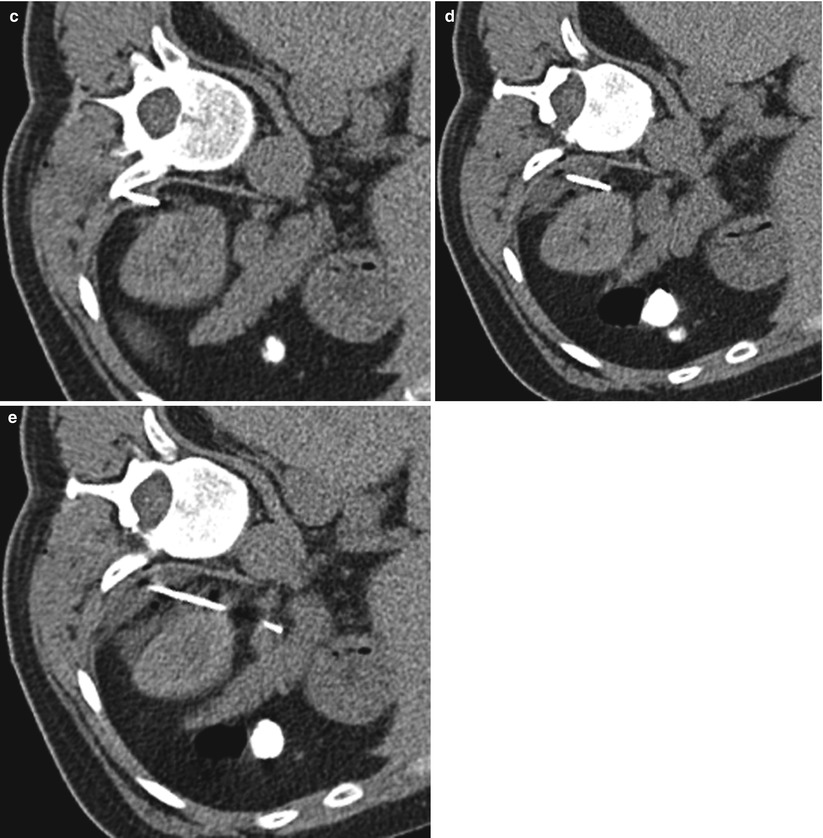 Adrenal Gland Biopsy | Radiology Key