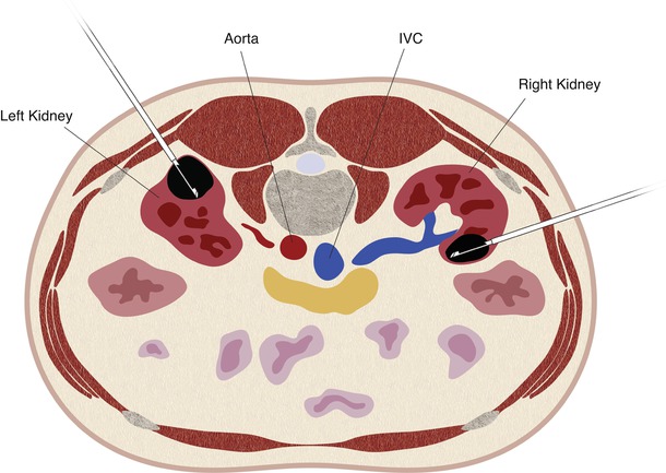 Renal Mass Biopsy | Radiology Key