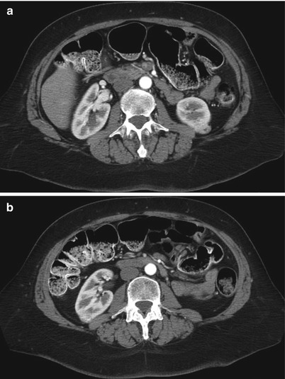 Renal Mass Biopsy | Radiology Key