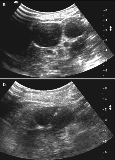 Nodes and Soft Tissue Masses Involving the Retroperitoneum, Mesentery ...