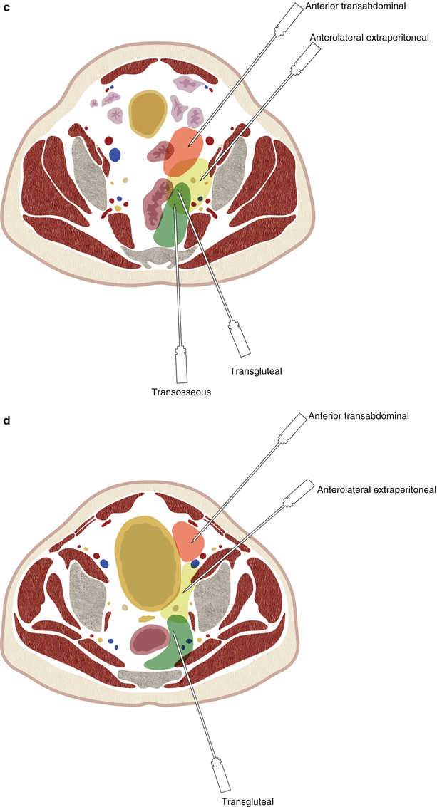 Biopsy of Pelvic Lesions | Radiology Key