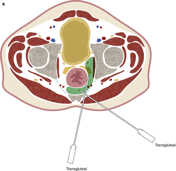 A162170_1_En_20_Fig2c_HTML.gif